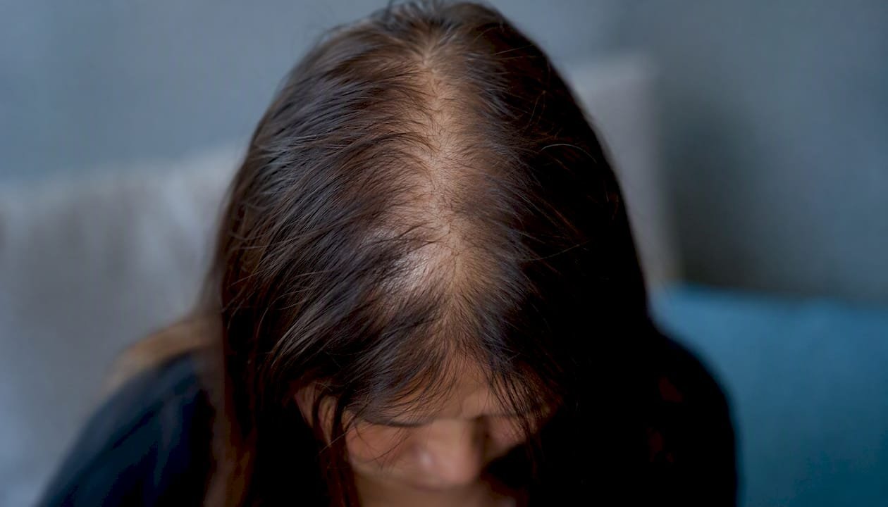Close-up of thinning hair at crown scalp